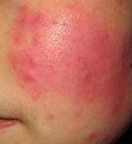 儿童脸上的红血丝有什么症状