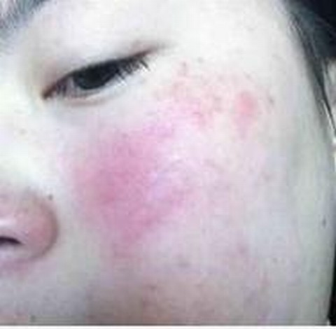 红血丝有什么危害