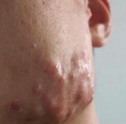 痤疮分为什么种类症状