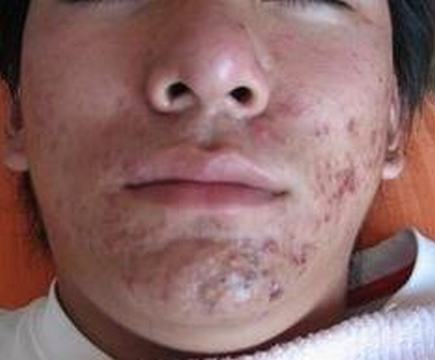 痤疮是如何导致的 怎样才可以根治 不留疤痕