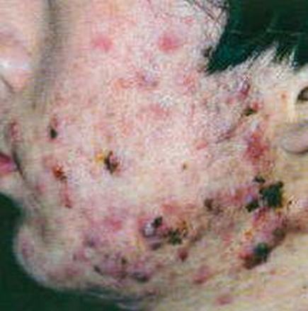 痤疮是一种因素引起的疾病
