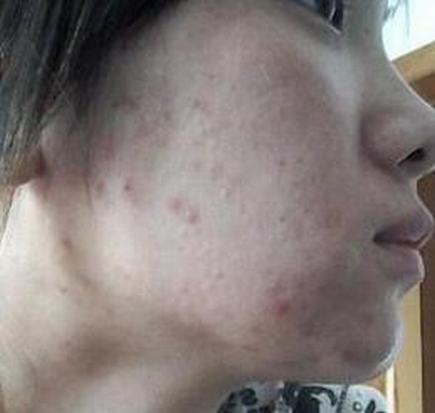 痤疮要如何护理呢