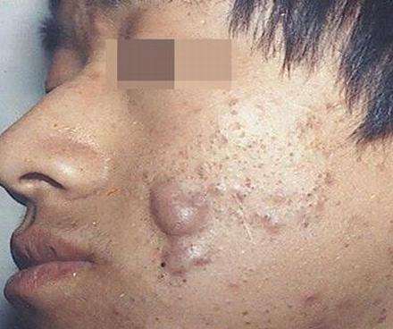 教你如何摆脱痤疮的烦恼