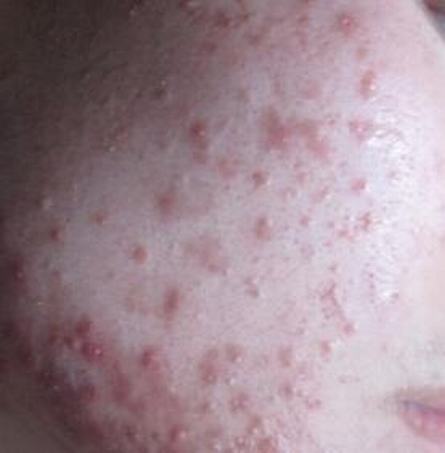 面部痤疮有几种不同的类型-