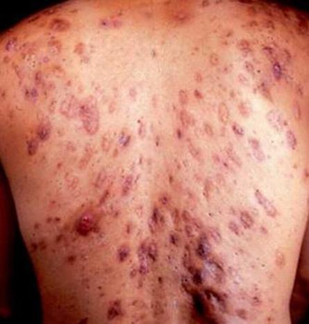 皮肤病医院专家告诉您  常见的痤疮的危害 
