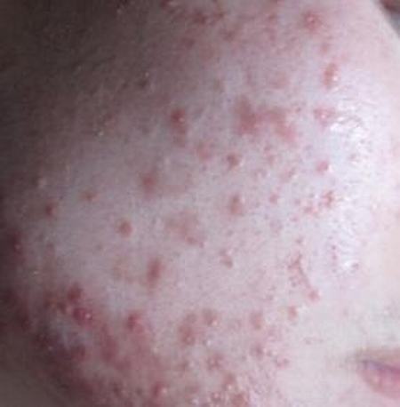医生讲解痤疮的症状