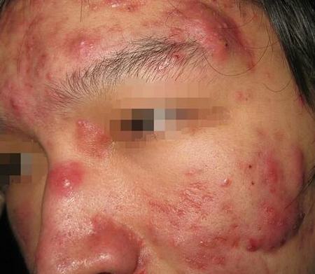 人得了痤疮久治不愈该怎么办 