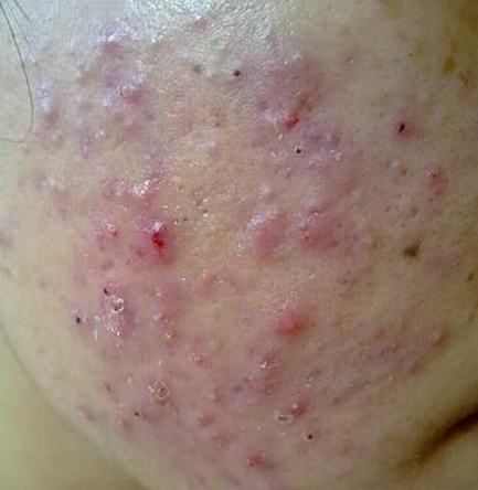 怎样的预防痤疮生成 