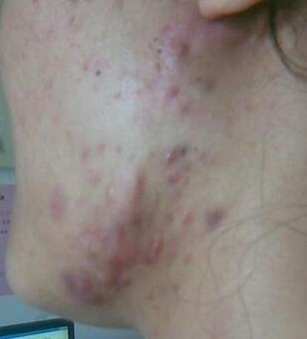 痤疮的原因和预防