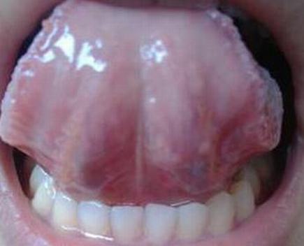 尖锐湿疣的早期的症状及好发位置