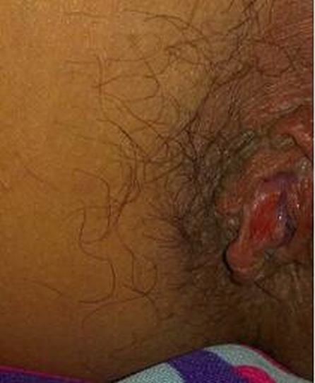 检测尖锐湿疣的办法有什么