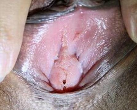 男性尖锐湿疣早期的症状