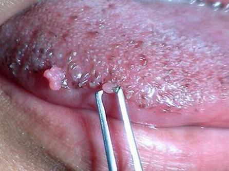 女性患有尖锐湿疣的原因 