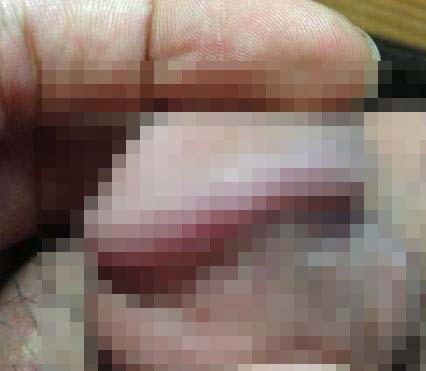 如何治疗假性尖锐湿疣