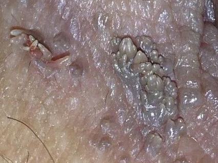 外阴湿疹与尖锐湿疣差异是什么