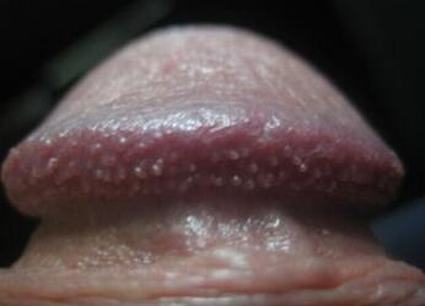 感染尿道口尖锐湿疣有哪些表现