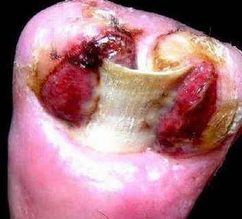 甲沟炎患者要及时重视其症状表现 