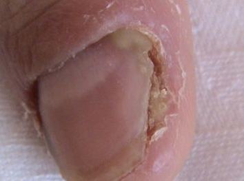 甲沟炎用什么药