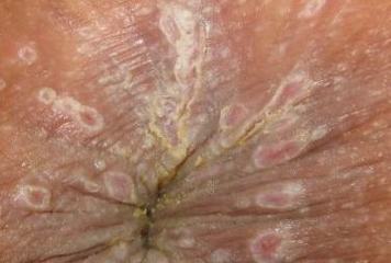 尖锐湿疣的初期病情表现