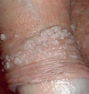 尖锐湿疣的初期病情表现有哪些