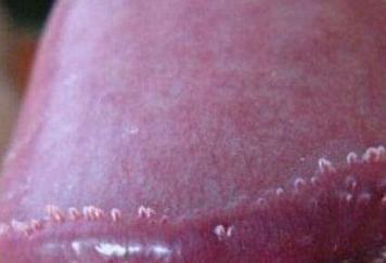 尖锐湿疣的初期病情是什么