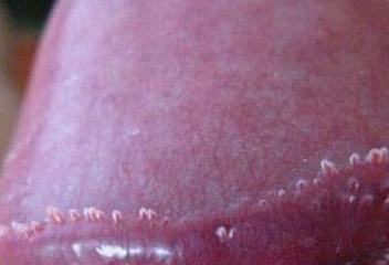 感染尖锐湿疣会在什么部位表现症状