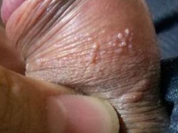 感染尖锐湿疣要怎样进行检查 