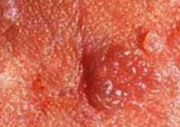 肛周尖锐湿疣的病因是什么 