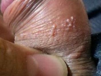 患尖锐湿疣会影响生育吗 