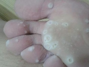 脚气的症状及治疗