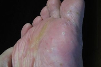 脚气患者会有什么症状出现呢