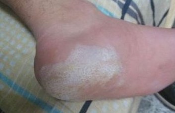 脚气患者需谨记的特别注意