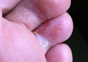 脚气患者需要吃些什么
