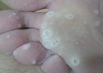 患上脚气的有什么原因