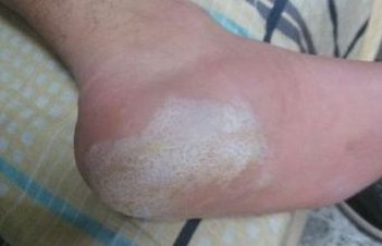 脚底长水泡很痒