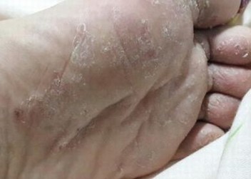脚气的简介