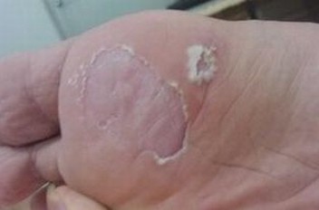 脚气的类型表现有哪些