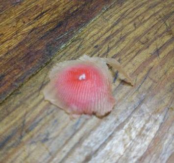 鸡眼应怎样护理