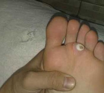 鸡眼的好发人群以及患病了怎么办