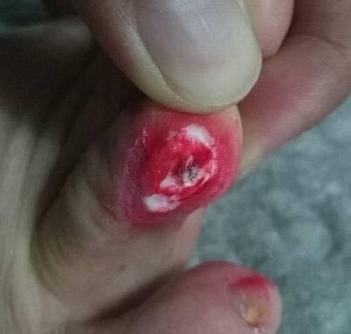 鸡眼的形成是怎样的