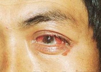 淋病的普遍症状有哪些