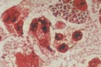 淋病奈瑟菌感染要求注意哪些