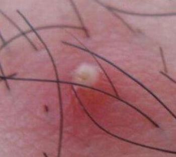 拔胡须拔出毛囊炎