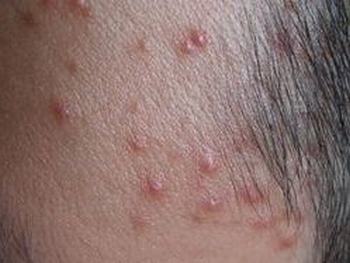糠秕孢子菌毛囊炎的临床症状有哪些