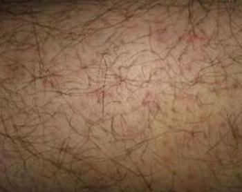 糠秕孢子菌毛囊炎的体征表现有哪些