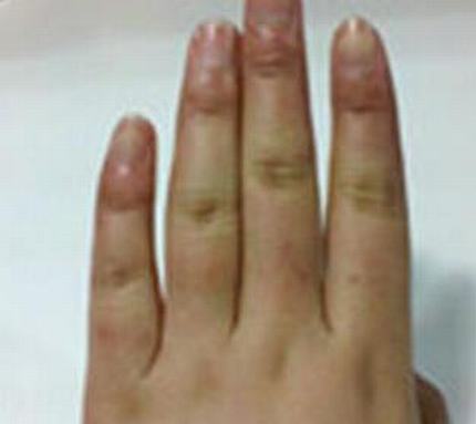 冻疮该怎样的预防呢