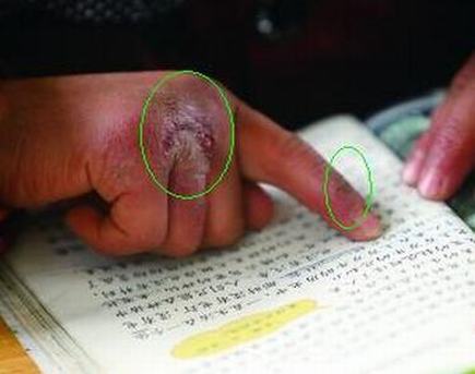 冻疮溃烂怎么办
