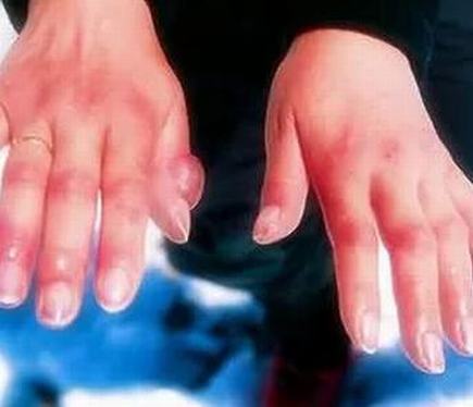 冻疮是如何产生的