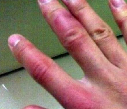 冻疮症状有什么分类