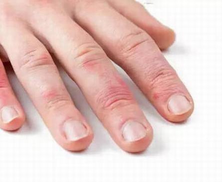 患了冻疮怎么治疗